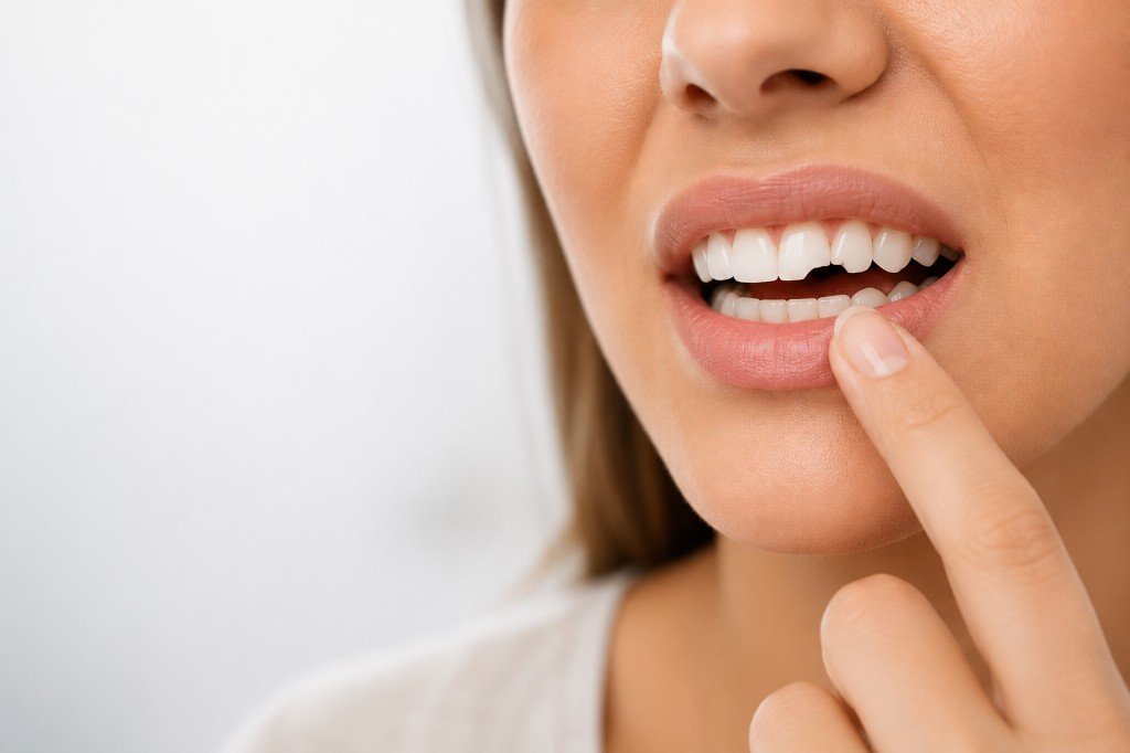 Broken or Chipped Tooth at Hill Top Dental Group