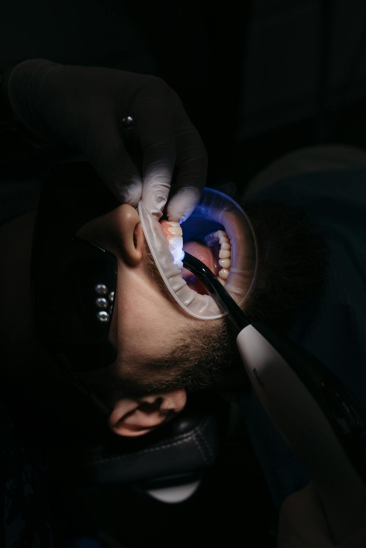 Tooth-Coloured Fillings at Hill Top Dental Group