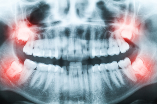 Wisdom tooth extraction procedure
